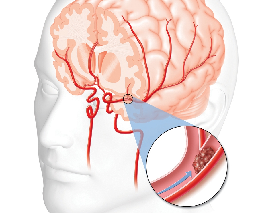 articulația umărului doare după un accident vascular cerebral