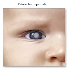 Cataracta congenitala si impactul ei vizual la copilul mic • ProVisual
